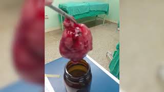 Se recupera de manera satisfactoria primer recién nacido operado de teratoma del mediastino en Cuba