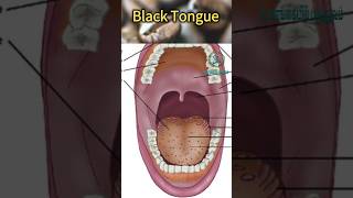 நாக்கு கருமையாதல் ஏன்| Black tongue causes| Tongue Blackening|கரு நாக்கு ஏற்பட காரணங்கள் #tongue