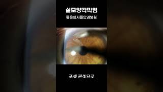 실모양 각막염