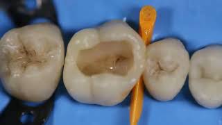 GC G-ænial A’CHORD: Simplified Universal Composite for Aesthetic Restorations.