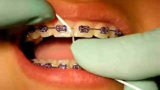 Bracesquestions.com - Flossing With Braces, How to Floss Teeth