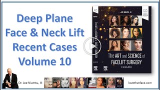 Deep Plane Facelift Recent Cases Volume 10