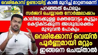 ഇങ്ങനെചെയ്താൽ സർജറി വേണ്ട വെരിക്കോസിലെ അശുദ്ധരക്തം മുഴുവനായി പുറത്തു പോകും സർജറി വേണ്ട|Vericose vein