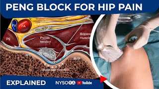 PENG BLOCK FOR HIP PAIN - NYSORA's Regional Anesthesia Clinical Cases