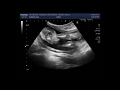 Ultrasound Video showing Club foot fetal anomaly scan.