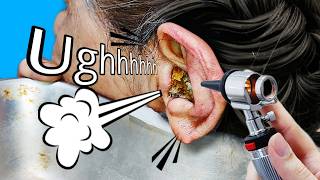 Overflowed Ear Wax #earwaxremoval #earwaxcleaning #satisfying