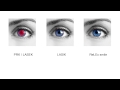 relex smile compared to lasik and prk in english