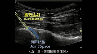 五十肩-肩關節擴張注射( Frozen shoulder ultrasound-guided hydrodilatation)