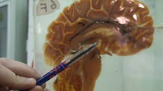 plastination of the brain video 2 | anatomy | 2nd grade | Dr.Mariam Wahby