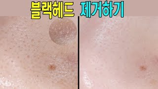 ENG] 블랙헤드 뿌리뽑자! 피지제로, 블랙헤드 제거하는 법 / How to Remove Blackheads / 듬아