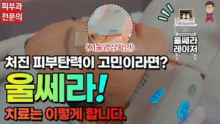 울쎄라 리프팅 처진피부탄력, 팔자주름, 볼처짐, 이중턱, 제네시스 콜라보시술(피부과전문의 피부맨)