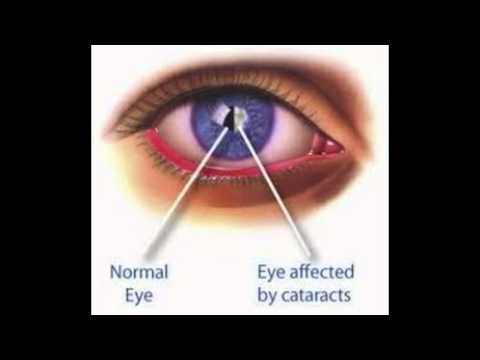Is it safe to fly after cataract surgery?