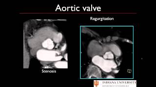 Post Processing Cardiac CT