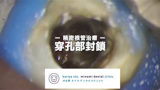 精密根管治療 　【愛知県刈谷市の歯医者】　穿孔部封鎖　バイオセラミックス　自由診療　顕微鏡歯科　マイクロスコープ　Closing canal perforation using BC　Kariya