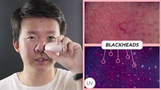 [BOYFRIEND'S BLACKHEADS😱] Labelle Sonic Peel L5 - Ultrasonic Cleanser