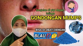 BENARKAH BLAU BISA MENGOBATI PENYAKIT GONDONGAN - BENJOLAN PADA PIPI