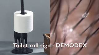 How to identify demodex   the toilet roll sign!