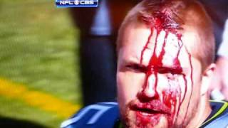 Owen Schmitt, fullback for the Seattle Seahawks, voluntarily busts his head open.