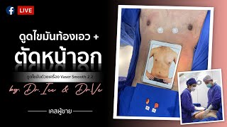 รีวิวผ่าตัดหน้าอก ผู้ชายมีนม (Gynecomastia) พร้อมดูดไขมันหน้าอก