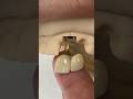 2-Unit Monet Pure Zirconia Bridge @EnvisiontecMain #envisiontec #dental #teeth #lsk121shorts