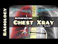 Reading a chest X-ray | Radiology