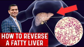 How To Reverse A Fatty Liver | Fatty Liver - How To Fix It
