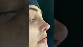 reconstructive rhinoplasty | جراحی ترمیمی بینی با پیوند غضروف دنده