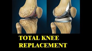 Total Knee Replacement / Knee Arthroplasty: Restoring Mobility and Relieving Pain