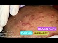 Mụn ẩn siêu nhiều mụn mủ viêm|Big acnes pimples,pusstule,blackheads extraction Dr Hoan 0985773391