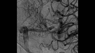 WEB 17 device for unruptured MCA aneurysm