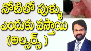 నోటిలో పుళ్ళు ఎందుకు వస్తాయి || Mouth Ulcer ||  Telugu Dental Tips in Telugu || Dr Raos Dental