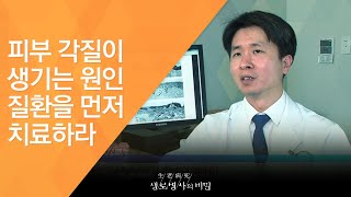 피부 각질이 생기는 원인 질환을 먼저 치료하라 - (2016.1.27_569회 방송)_때 밀어도 될까?