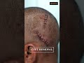 Cyst removal #shorts