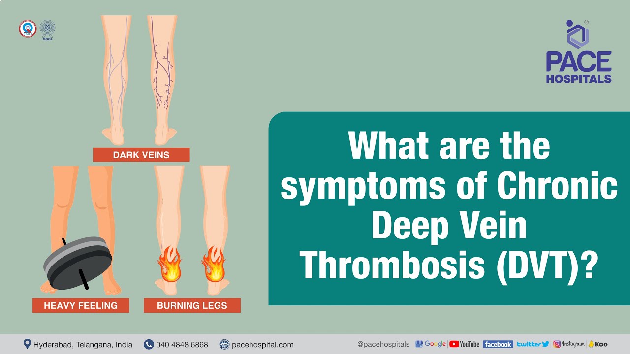 Deep Vein Thrombosis Dvt Symptoms Causes And 50 Off