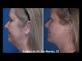 The 10 Most Common Complaints during Facelift Recovery