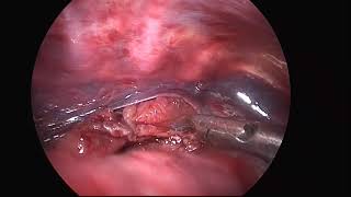 Thoracoscopic (VATS) repair of Esophageal atresia with Tracheoesophageal Fistula (EA-TEF/TOF)