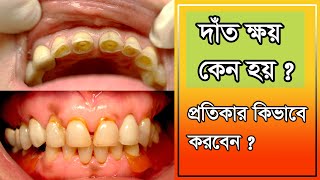 দাঁতে ক্ষয় কেন হয় ? দাঁতের ক্ষয়ের চিকিৎসা || Tooth Decay Treatment In Bangla ||