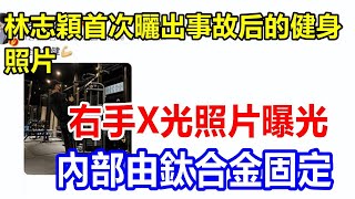 林志穎首次曬出事故后的健身照片，右手X光照片曝光，內部由鈦合金固定