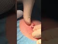 big squeeze cyst rupture popped