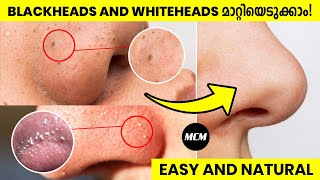 How to Remove Blackheads and Whiteheads Naturally at Home | Malayalam Skincare Video for Men