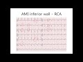 심전도 한 걸음 더 32. 급성심근경색 lcx vs rca