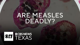 Infectious disease doctor answers measles FAQs