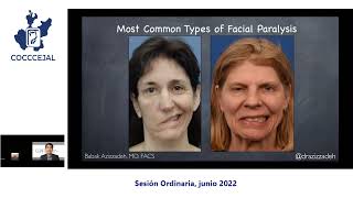 CIRUGIA PARA LA REANIMACION FACIAL-Dr. Babak Azizzadeh The Facial Paralysis Institute, Beverly Hills