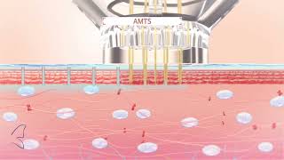 Introducing EPN Plus Microneedling with Electroporation