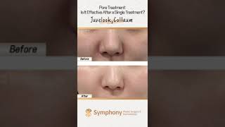 Juvelook, Collaum Pore Treatment: Is It Effective After a Single Treatment?