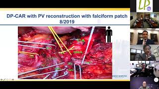 Locally Advanced Pancreas Cancer; Management and Operative Techniques