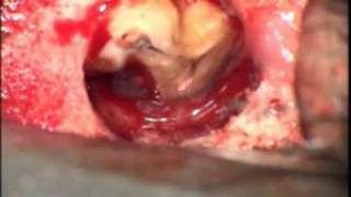 Dr. Jason Deblinger root canal surgery! MICROSCOPIC APICOECTOMY!!!MAXILLARY PREMOLAR 3 ROOTS!!!!