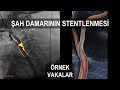 Şah Damarındaki (Karotis) Darlığın Stent ile Ameliyatsız Açılması: Örnek Vakalar