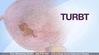 TURBT - Trans-Urethral Resection of a Bladder Tumour - Professor Mohamed H Khadra