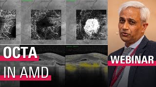 Identifying CNV with OCT Angiography Imaging